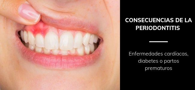 consecuencias periodontitis